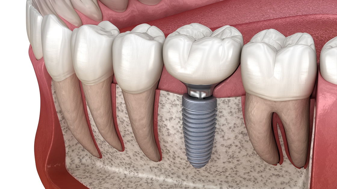 Coût des implants dentaires pourquoi choisir la Hongrie